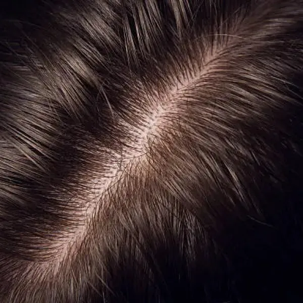 Minoxidil – How It Supports Hair Growth and What You Should Know Minoxidil – How It Supports Hair Growth and What You Should Know