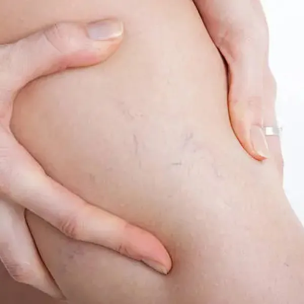 Spider Veins – What They Are and How to Treat Them Spider Veins – What They Are and How to Treat Them